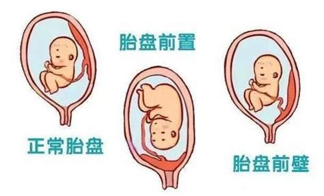 植入性胎盤 消失的你中国